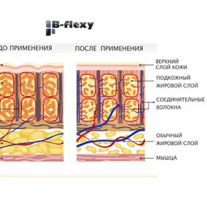 Программа анти-целлюлитного аппаратного массажа B-flexy