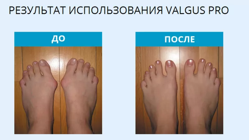 VALGUS PRO в Беларуси 3